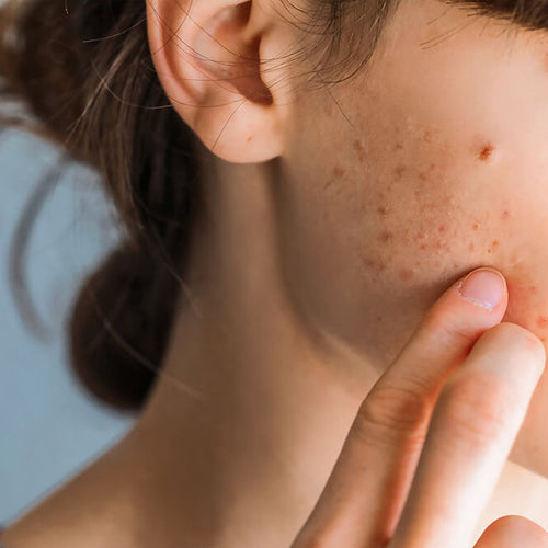 Top 3 Benefits of Using a Dermatologist-Approved Acne Treatment System