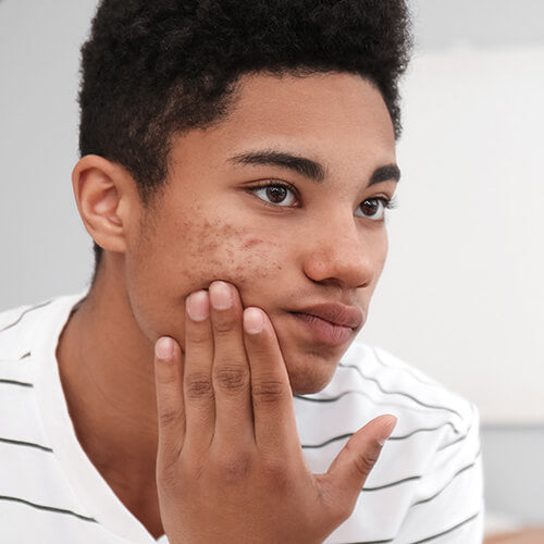 A teen boy looking at his acne in the mirror