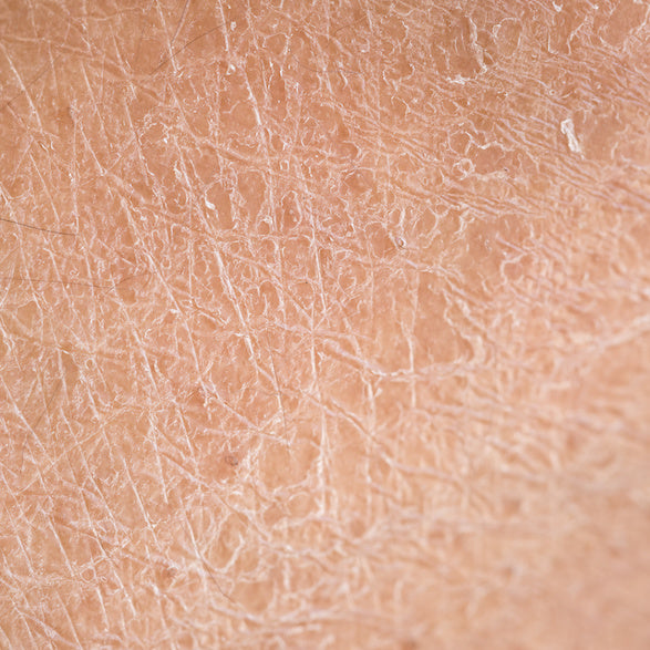 Dry or dehydrated skin before treatment with hydration and moisturizer