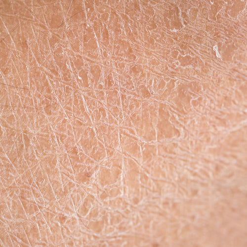 Dry or dehydrated skin before treatment with hydration and moisturizer