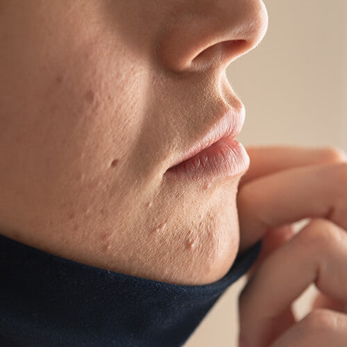 A woman with maskne, acne mechanica on her chin