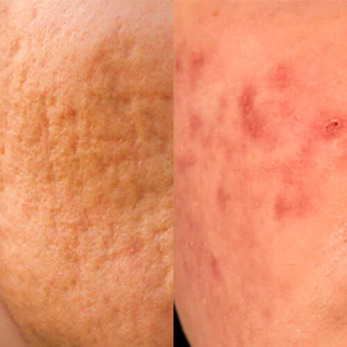 Closeup comparison photos of acne scarring and acne post-inflammatory hyperpigmentation