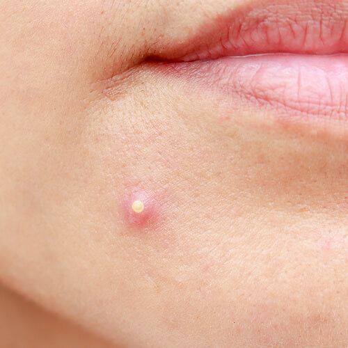 A pimple that needs spot treatment