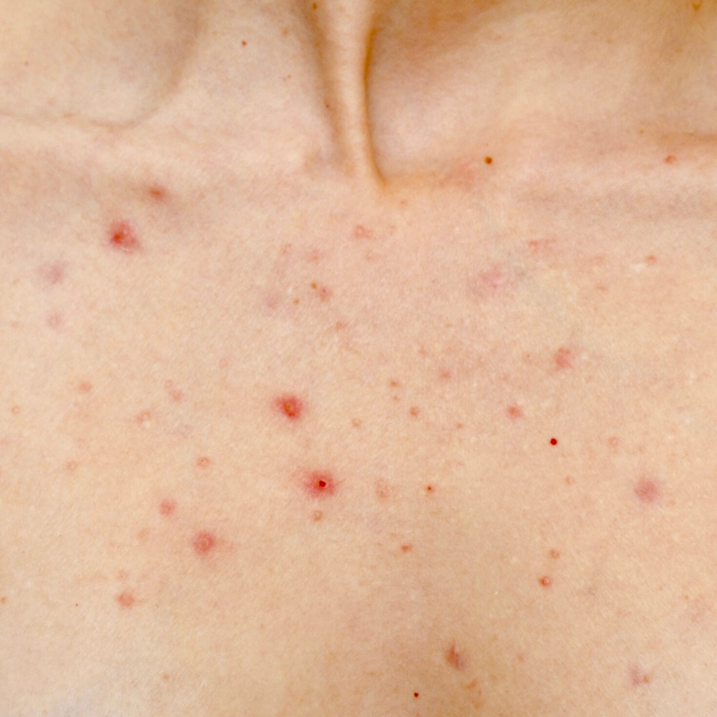 A woman with body acne on her upper chest