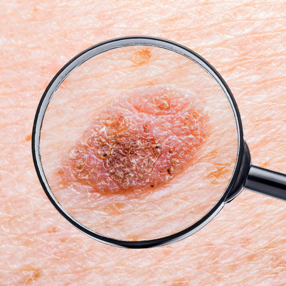 A magnified image of a suspicious mole that could be skin cancer