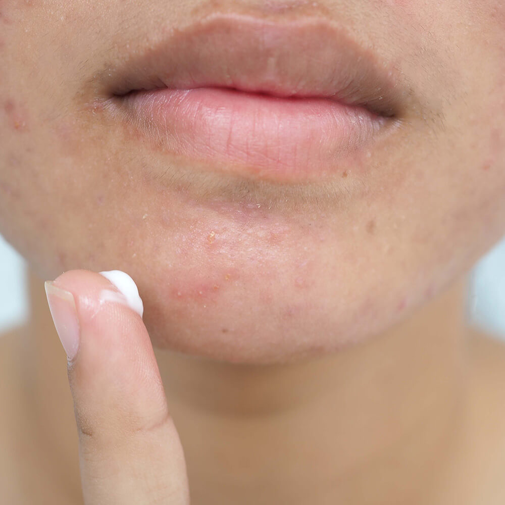 A woman getting started on her acne treatment
