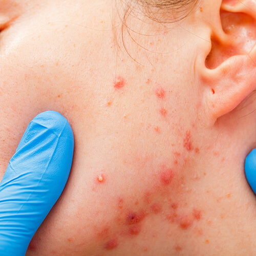 A woman with cystic acne that may benefit from treatment with Accutane