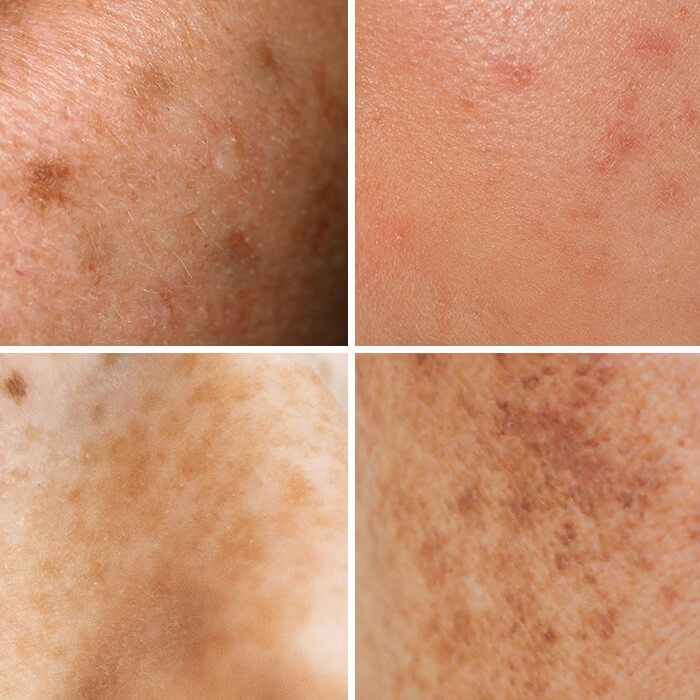 Four types of skin hyperpigmentation
