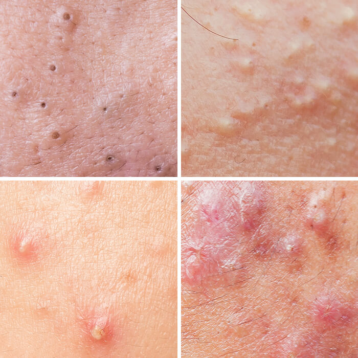 Acne blackheads, whiteheads, papules and pustules