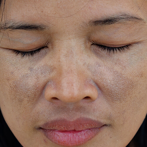 A woman with patches of melasma, a type of hyperpigmentation, on her cheeks