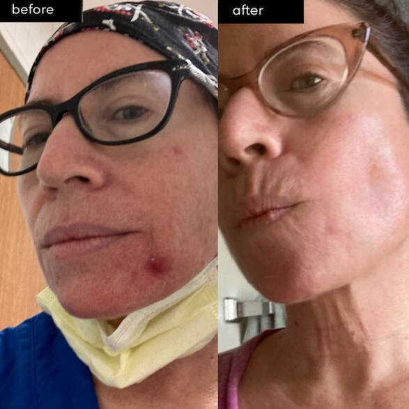 Breaking Down Mask Irritation