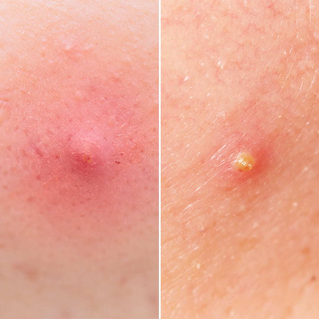 An acne papule and pustule up close
