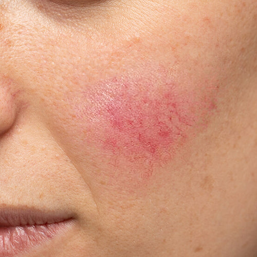 A woman with redness from rosacea