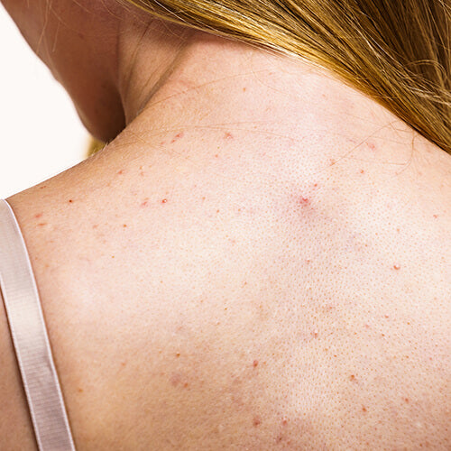 A woman's back with body acne aka bacne
