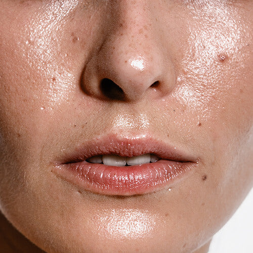 Oily skin from excess sebum