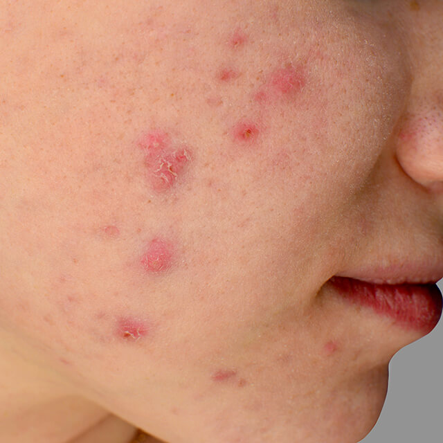 Closeup photo of woman with cystic acne lesions on her face