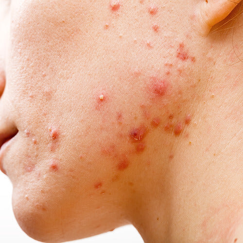 What nodulocystic acne looks like