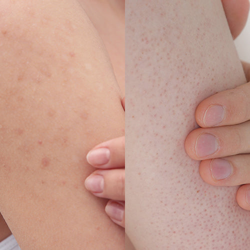 Difference between body acne and keratosis pilaris
