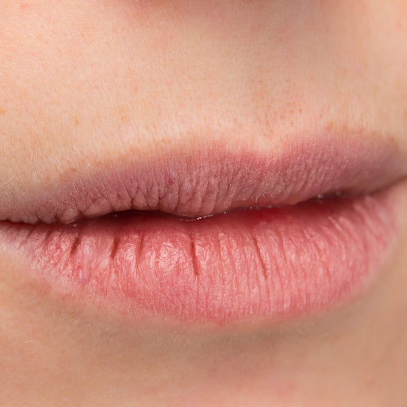 A closeup photo of chapped lips that need to be treated