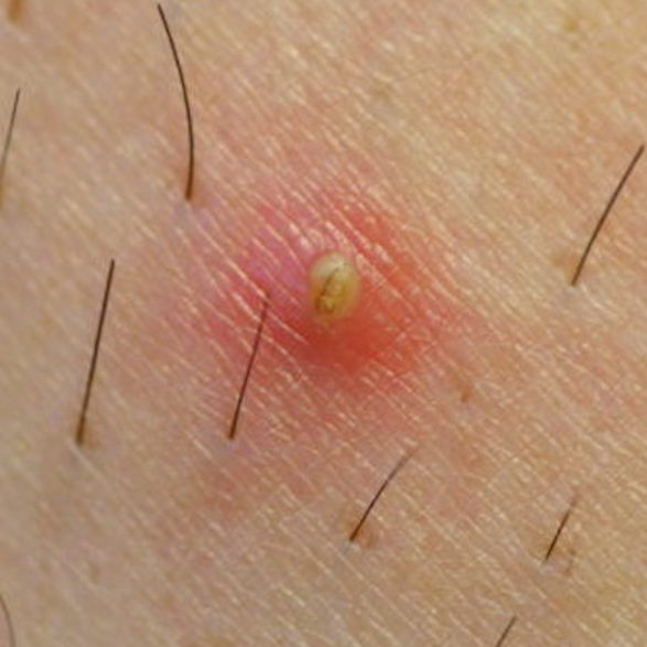 An ingrown hair that can be treated according to Dr. Pimple Popper