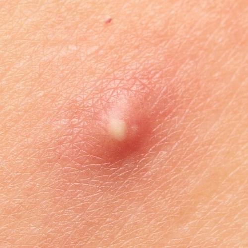 An acne pustule before treatment with Spot Check Acne Patches by SLMD Skincare