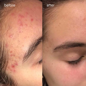Before and after shot of person with forehead acne.