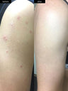 A before and after photograph of arm acne clearing up after using SLMD Body Acne System