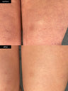 A before and after photo of smoother skin after using SLMD Body Smoothing System for keratosis pilaris