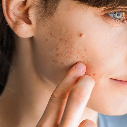 A young woman with pimples that may be managed with an acne system