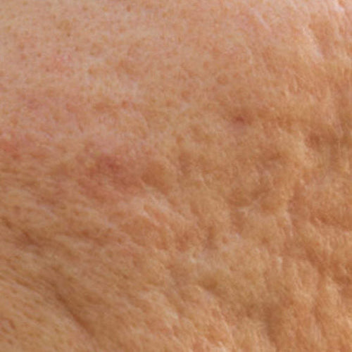 Rolling acne scars one of the 5 kinds of acne scars