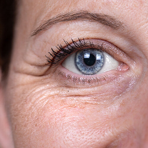 A woman with dynamic and gravitational wrinkles around her eyes