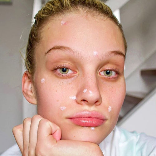 A woman with spot treatments on acne in different zones on her face