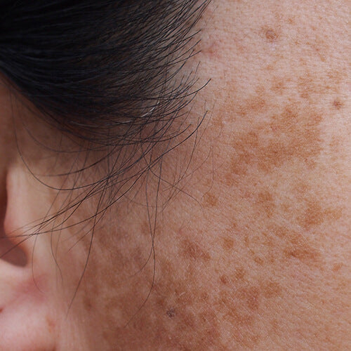 A woman with dark spots like melasma