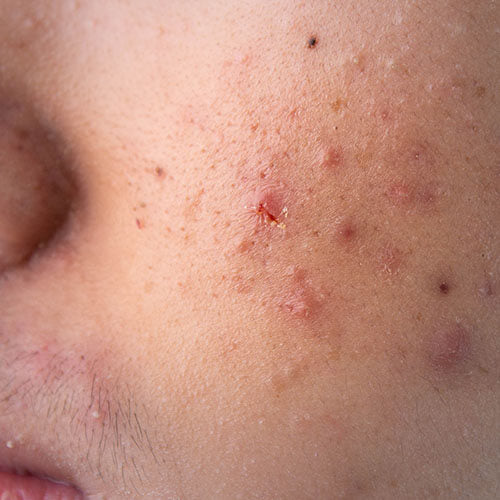 A man with inflammatory acne pimples
