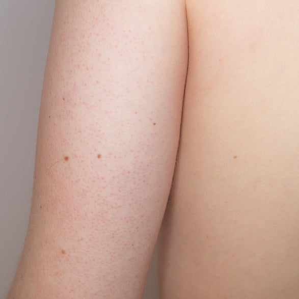 Keratosis pilaris aka chicken skin on the back of the arm