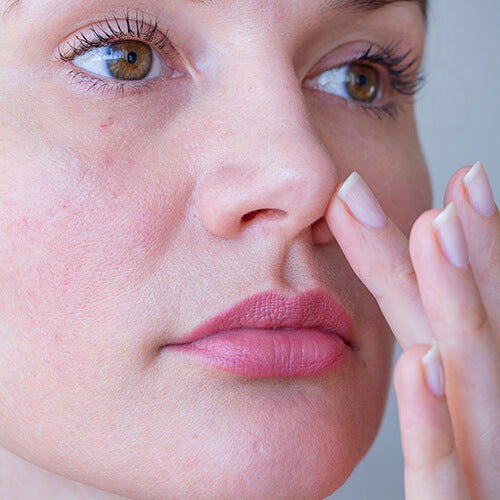 A woman with the skin condition rosacea