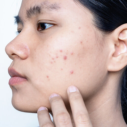 A woman with inflammatory pimples