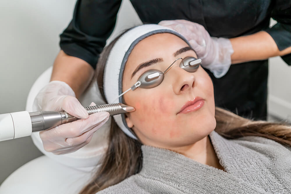 A woman receiving acne laser treatment