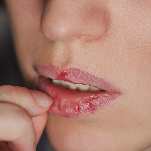 A woman with peeling lips who may have excoriation disorder