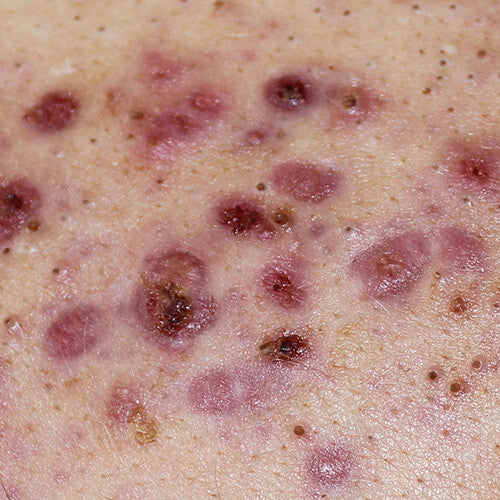 Acne conglobata is a rare form of acne