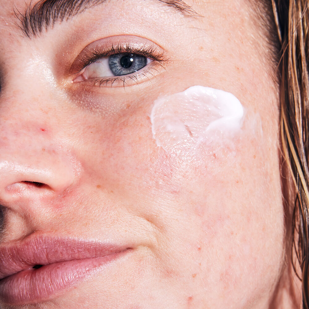 A woman with acne using SLMD Hyaluronic Acid Moisturizer
