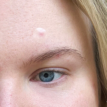 A woman wearing a clear, medicated Spot Check pimple patch from SLMD Skincare