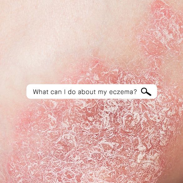 Everything You Need To Know About Eczema