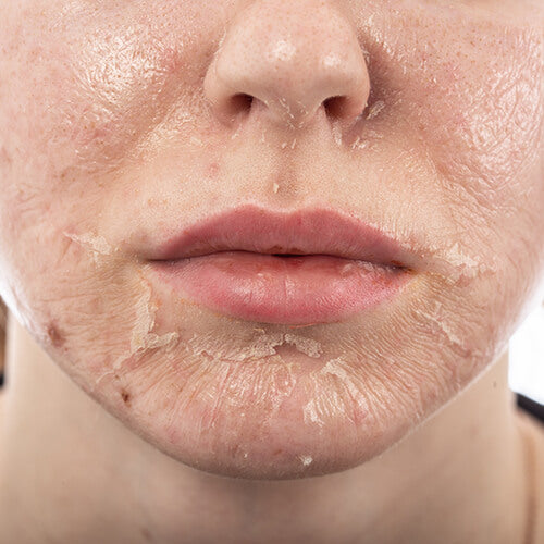 A woman's peeling face after a chemical peel