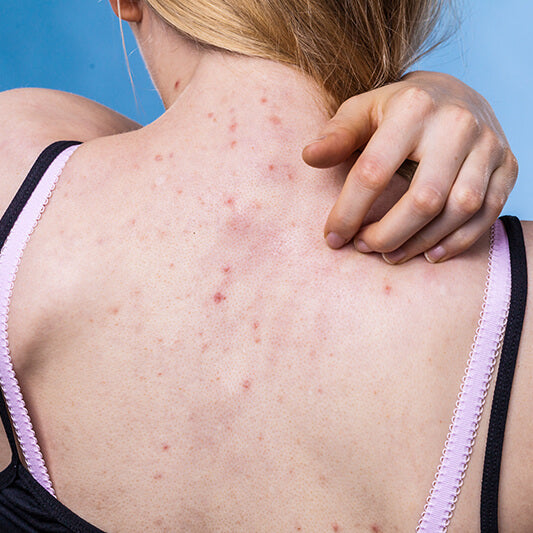 A woman with bacne that may turn into post inflammatory hyperpigmentation