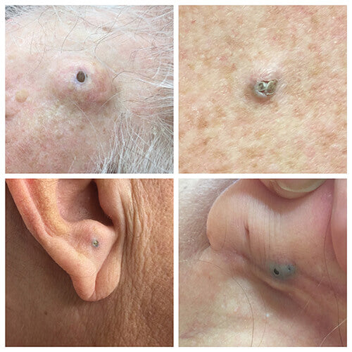 Huge blackheads called dilated pore of Winer DPOW