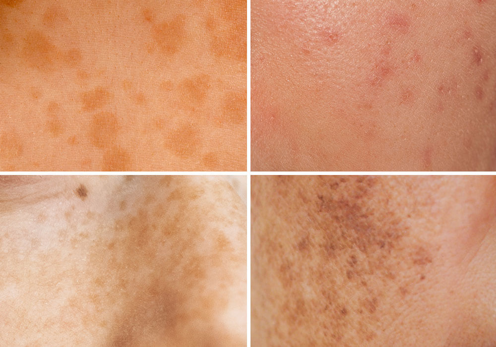 closeup photo of different types of skin hyperpigmentation