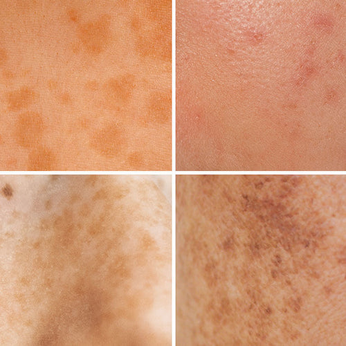 closeup photo of different types of skin hyperpigmentation