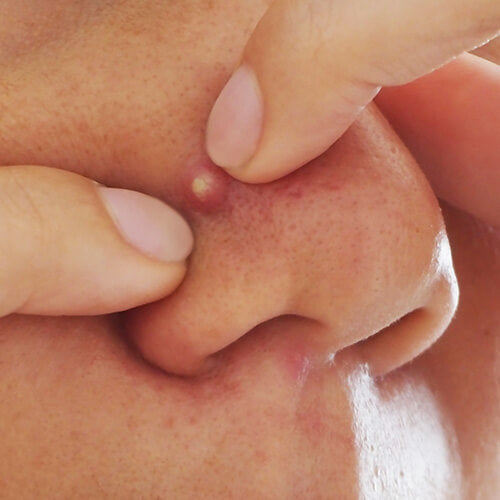 Picking a pimple which can damage skin