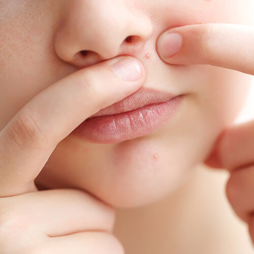 A young girl with an acne pimple that needs treatment